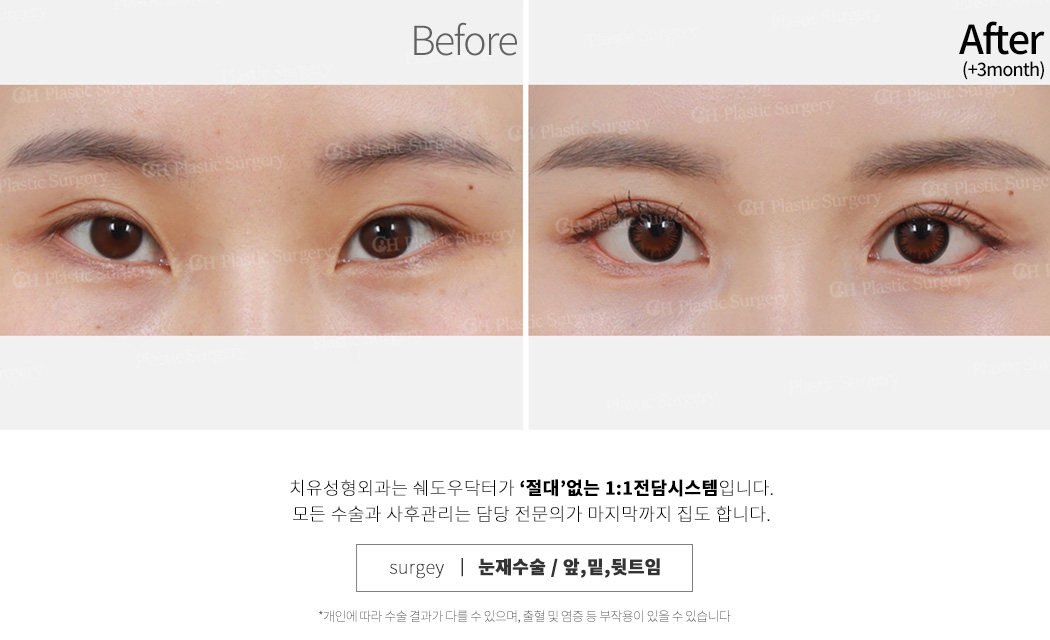 눈