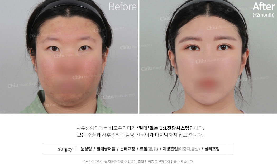 눈,지흡