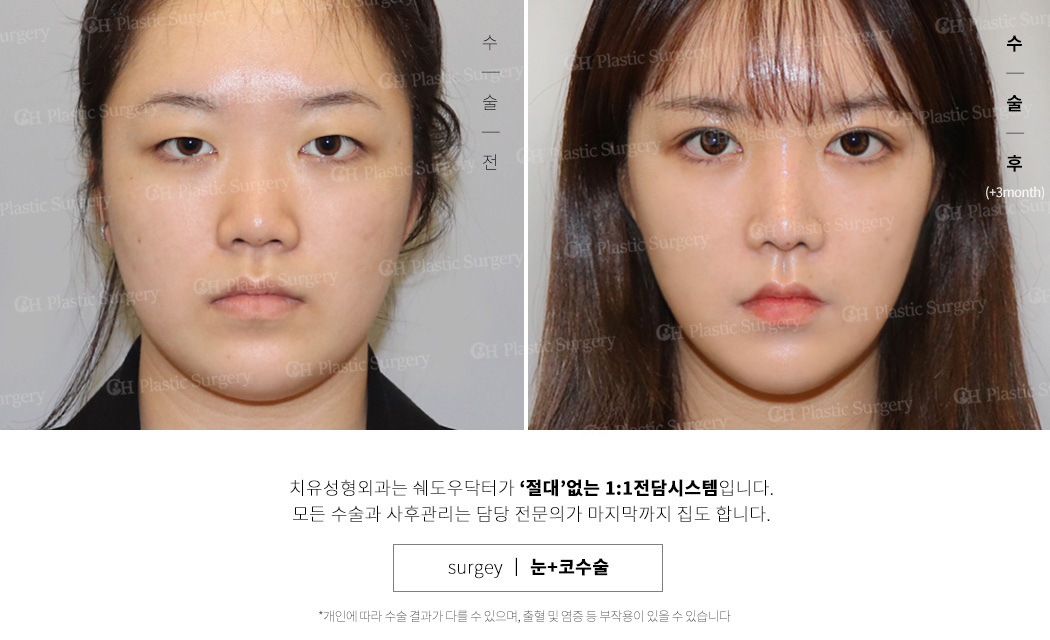 매부리코