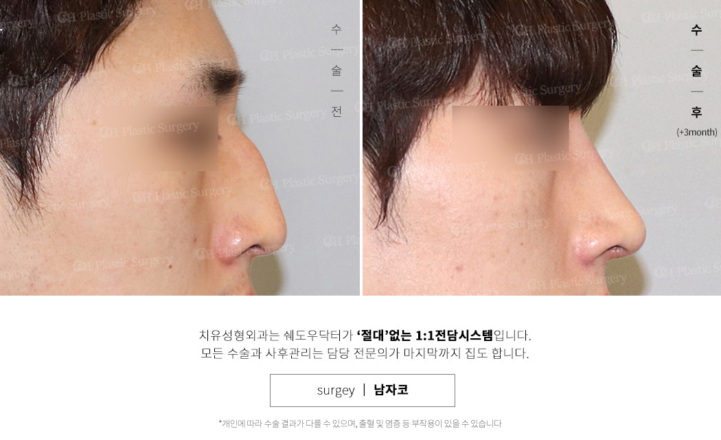 코수술