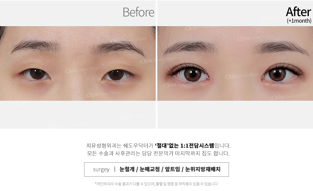 눈