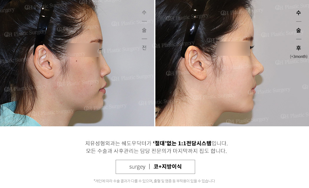 코재수술