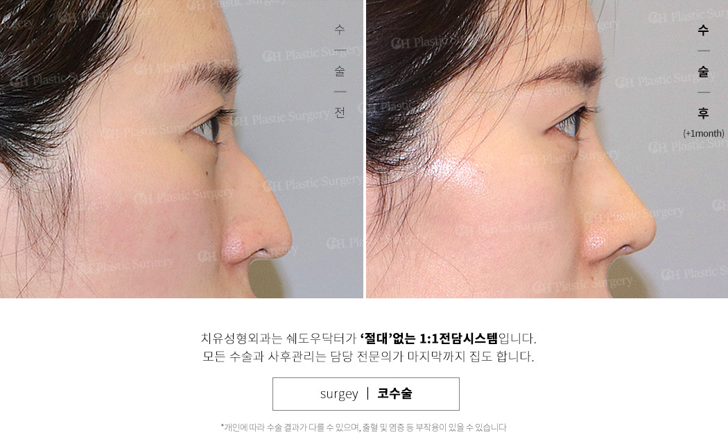 코재수술